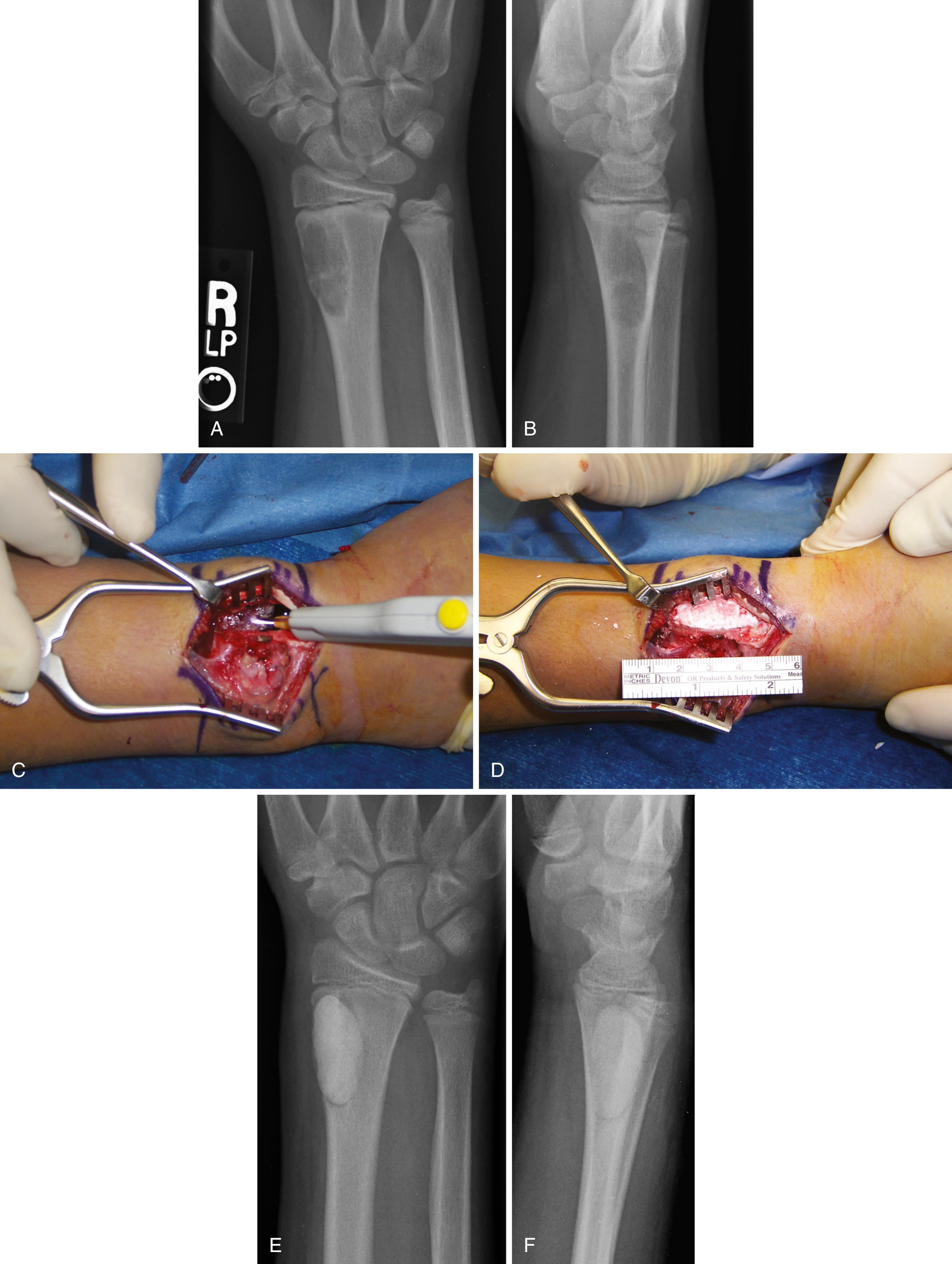 FIGURE 26.12, Chondromyxoid fibroma in a 14-year-old boy.