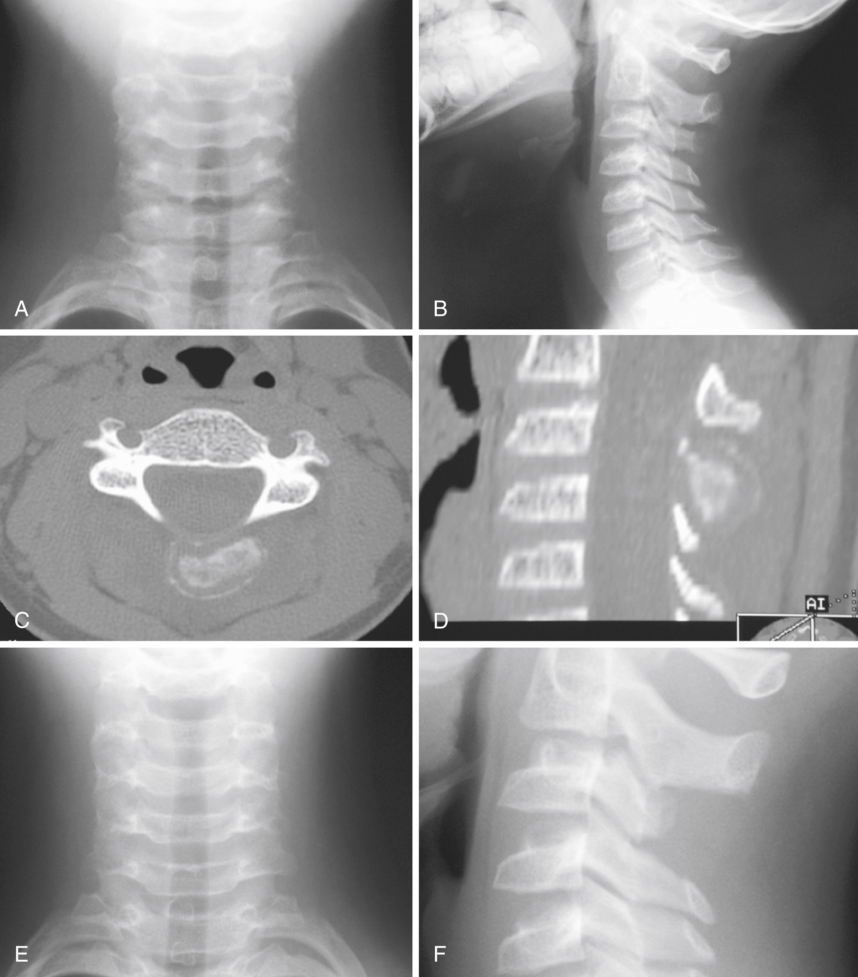 FIGURE 26.13, Ten-year-old boy with 1-month history of neck pain.