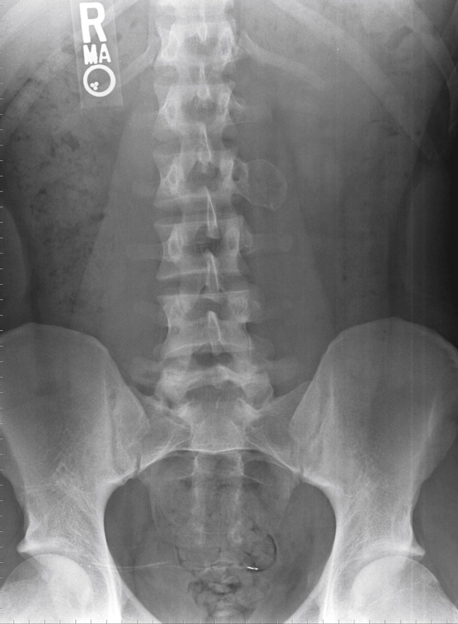 FIGURE 26.14, Anteroposterior radiograph of an 18-year-old boy with osteoblastoma of the left L2 transverse process.