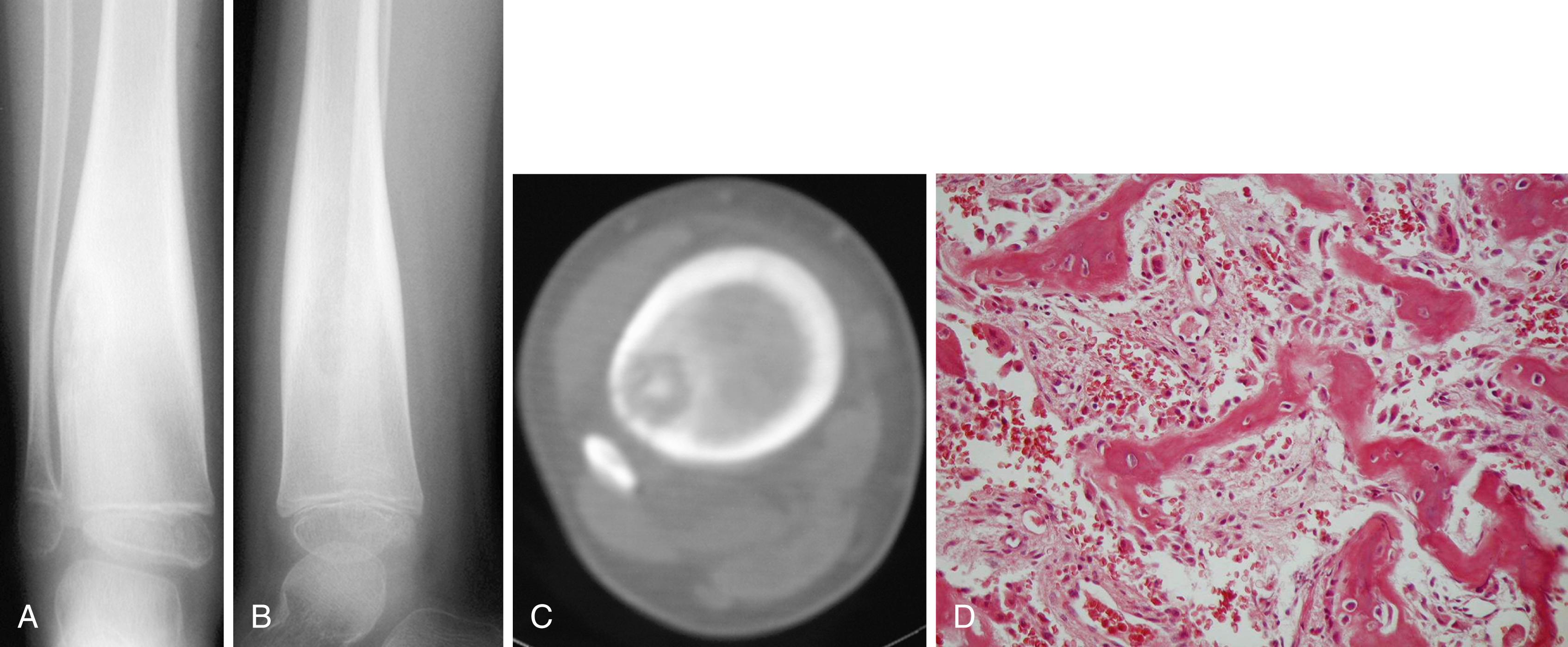 FIGURE 26.15, Four-year-old boy with a 1-year history of right leg pain.