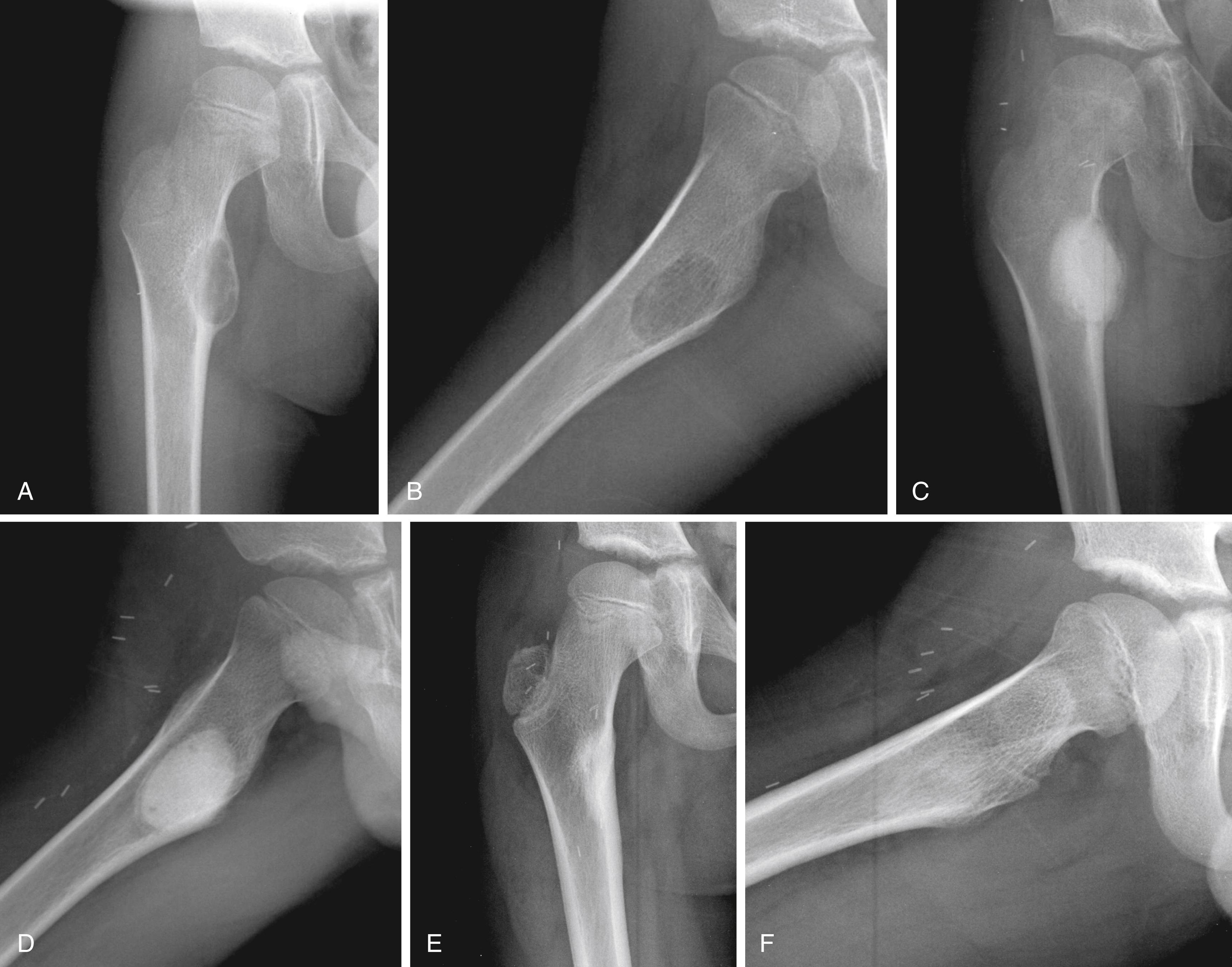 FIGURE 26.16, A and B, Anteroposterior and lateral radiographs of a 7-year-old boy with an osteoblastoma of the right lesser trochanter. C and D, Anteroposterior and lateral radiographs immediately after curettage and placement of a calcium sulfate/calcium phosphate bone graft substitute. E and F, Lateral radiographs 2 years later demonstrate remodeling of the bone with no sign of recurrence.