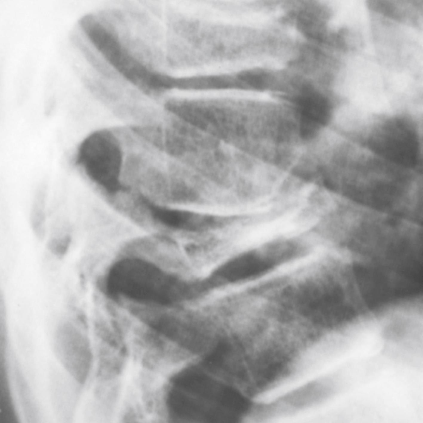 FIGURE 26.17, Eosinophilic granuloma of vertebral body.