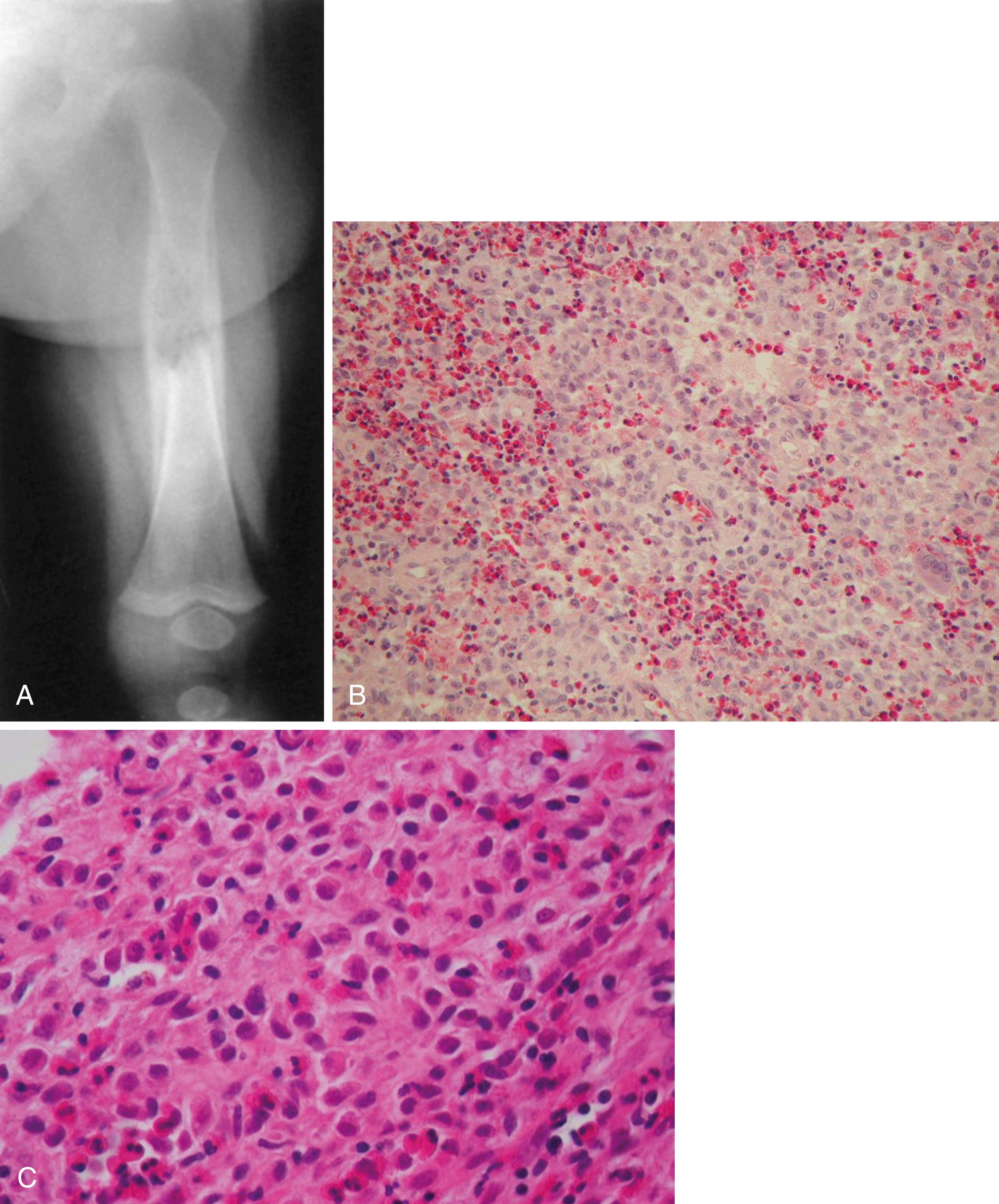 FIGURE 26.18, A, Solitary eosinophilic granuloma of femoral diaphysis causing severe periosteal reaction. B and C, Low-power and high-power photomicrographs demonstrate Langerhans cell histiocyte and eosinophils.