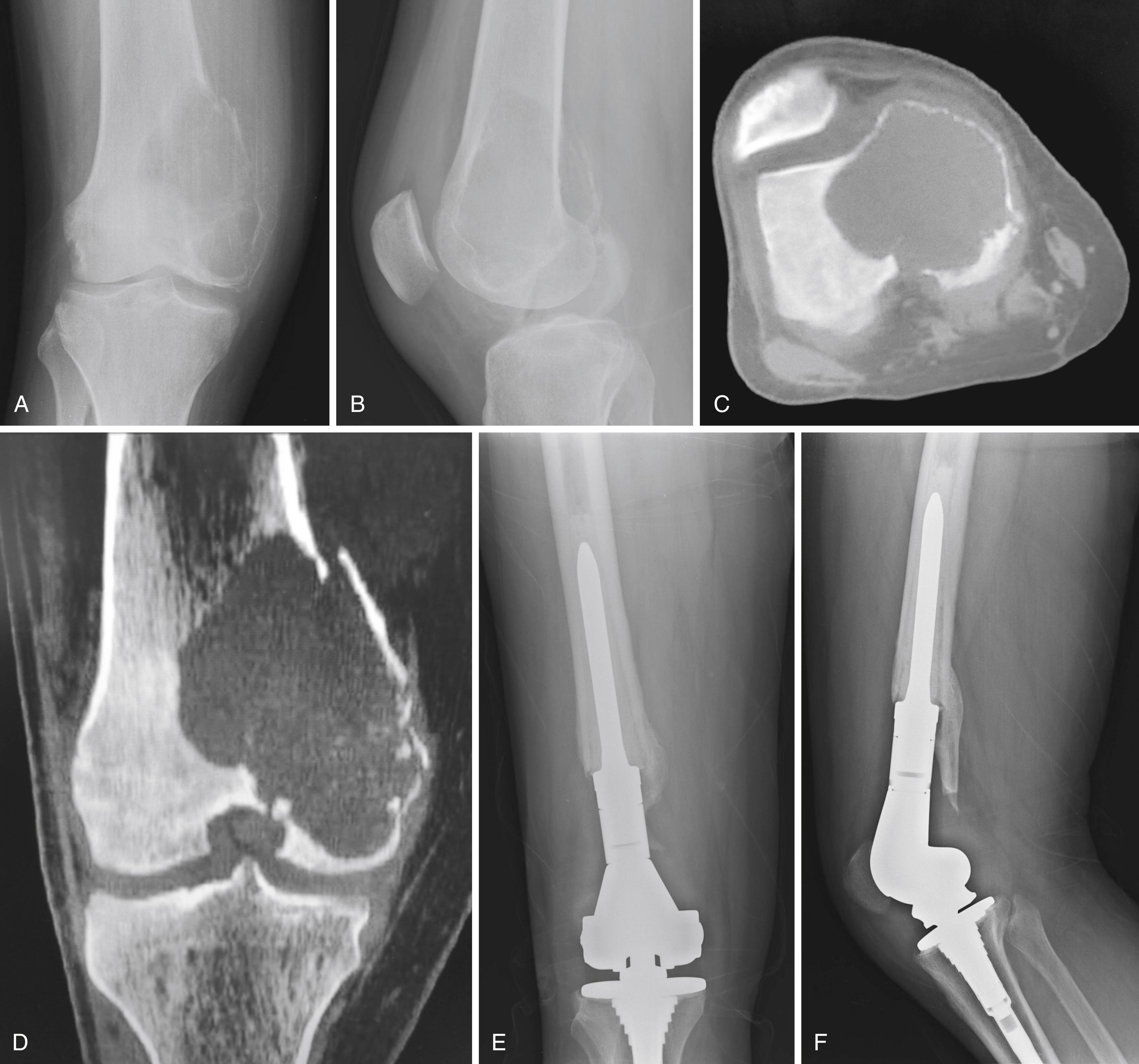 FIGURE 26.3, Anteroposterior (A) and lateral (B) radiographs of a 28-year-old man with a giant cell tumor of the right distal femur. Axial (C) and coronal (D) CT reconstructions demonstrate extensive bone destruction and an intraarticular pathologic fracture. The decision was made to proceed with en bloc resection and endoprosthetic reconstruction. Anteroposterior (E) and lateral (F) postoperative radiographs. Patient currently is doing well 8 years after surgery.