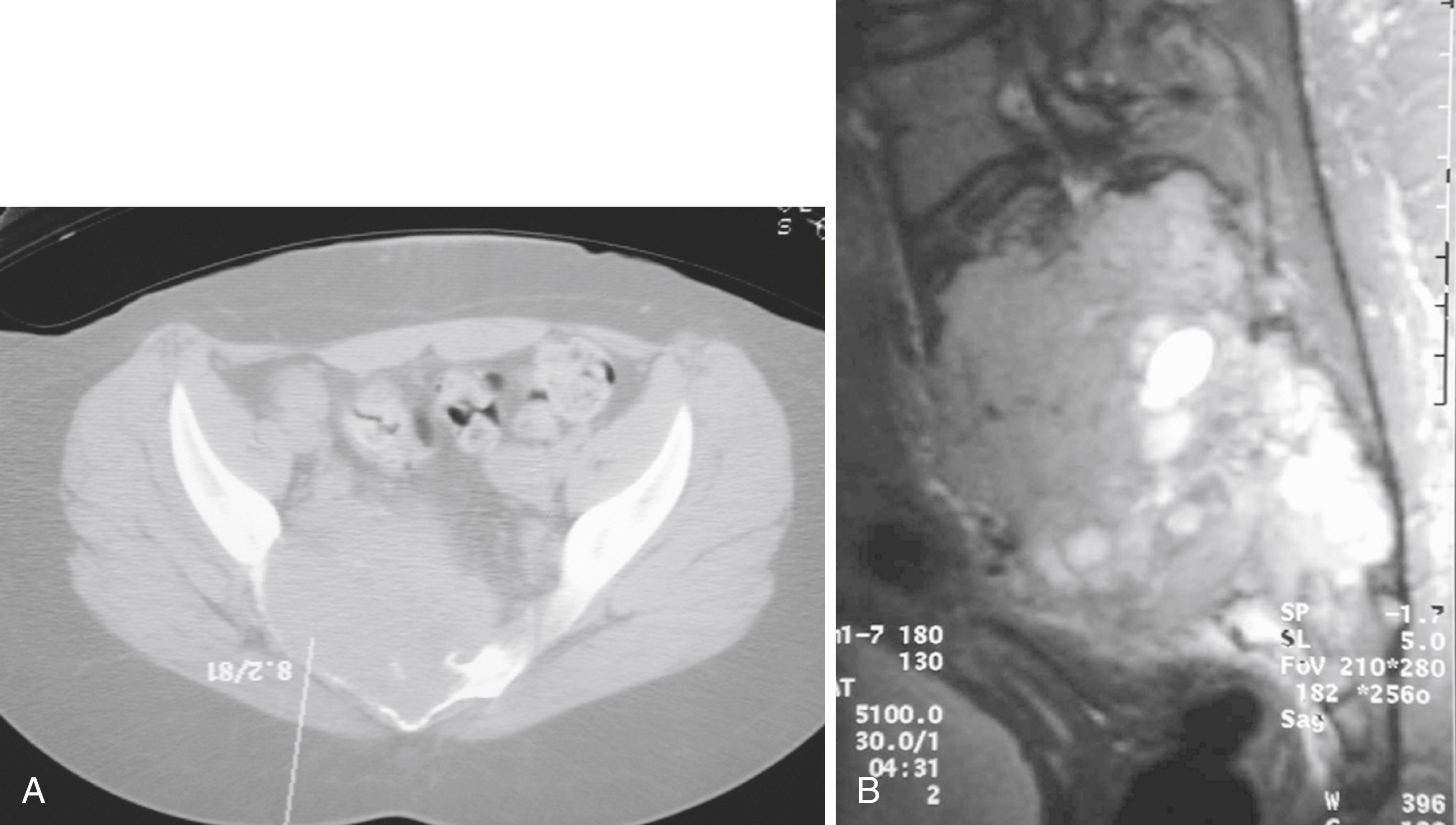 FIGURE 26.5, Giant cell tumor in 23-year-old woman.