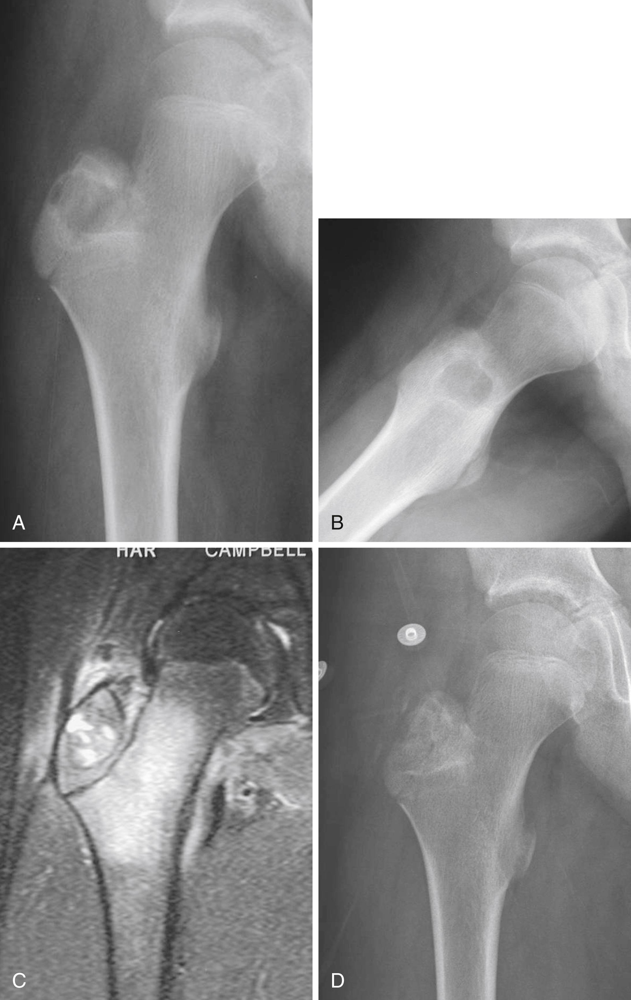 FIGURE 26.7, Chondroblastoma in a 12-year-old boy.