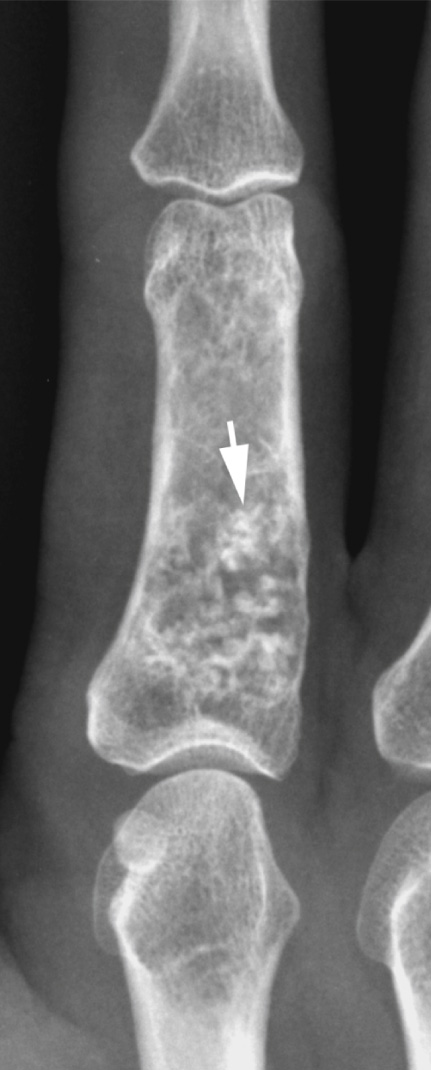 Enchondroma. AP radiograph of the index finger showing a lobular, mildly expansile lesion with typical chondral matrix mineralisation (arrow). **