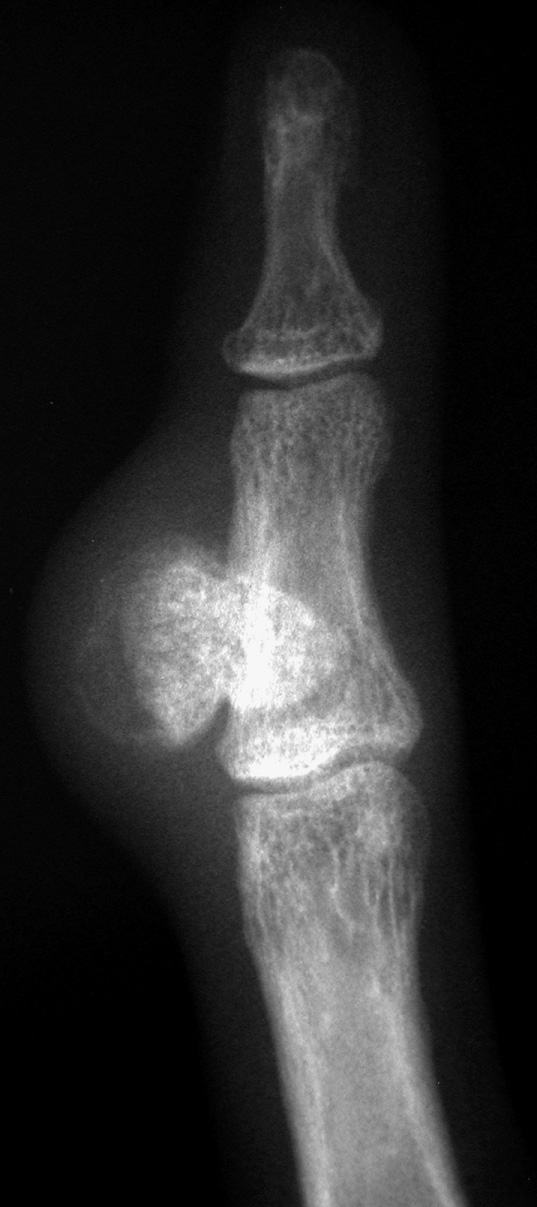 BPOP. AP XR showing a bizarre parosteal osteochondromatous proliferation adjacent to the middle phalanx. *