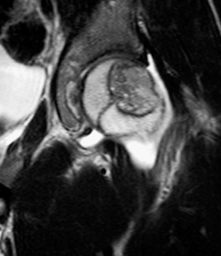 Chondroblastoma of the left femoral head. Coronal fat-suppressed T2WI showing the hypointense lesion with surrounding marrow oedema and reactive joint effusion. *