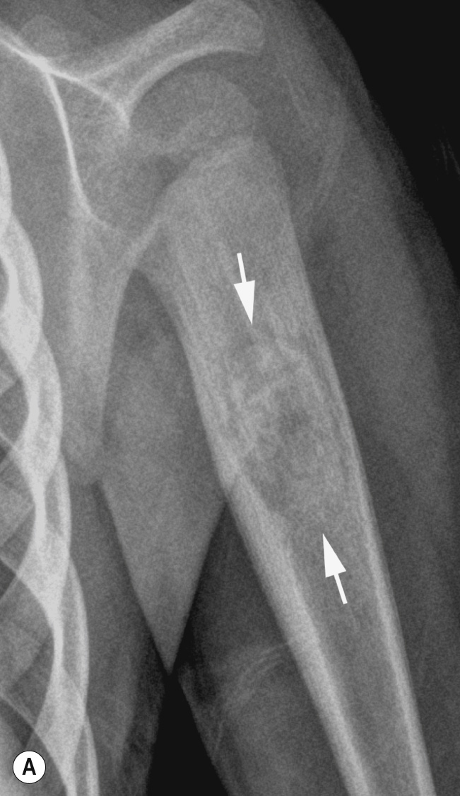 Osteoblastoma. (A) AP radiograph of the left proximal humerus showing a large mixed lytic-sclerotic lesion (arrows) in the medullary cavity with associated periosteal thickening. (B) Coronal CT MPR shows the oval, mineralised lesion (arrows). (C) Coronal STIR MRI demonstrates a hypointense tumour (arrows) with extensive reactive oedema-like marrow changes (arrowheads). **