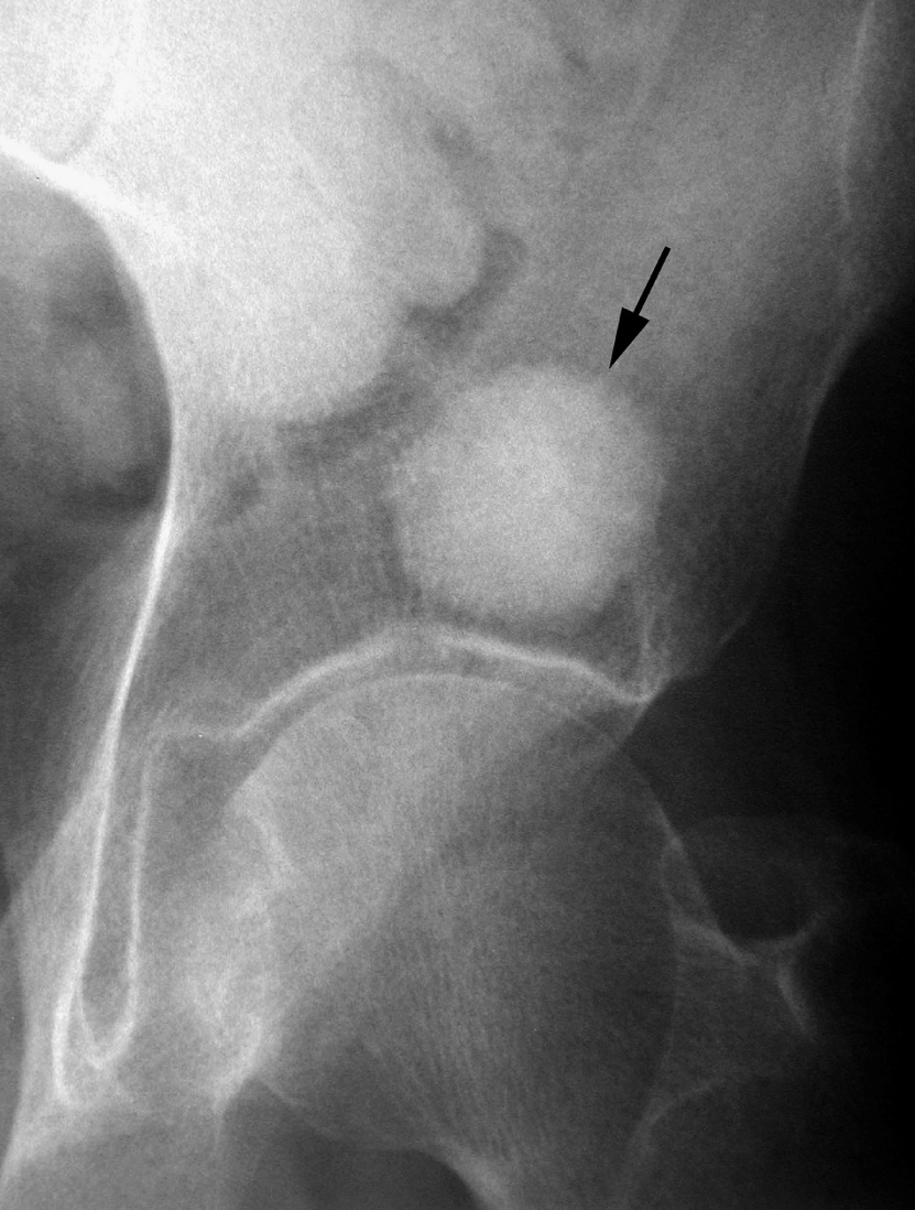 Giant bone island. AP XR showing a uniformly sclerotic bone island (arrow) in the supra-acetabular region of the ilium. *