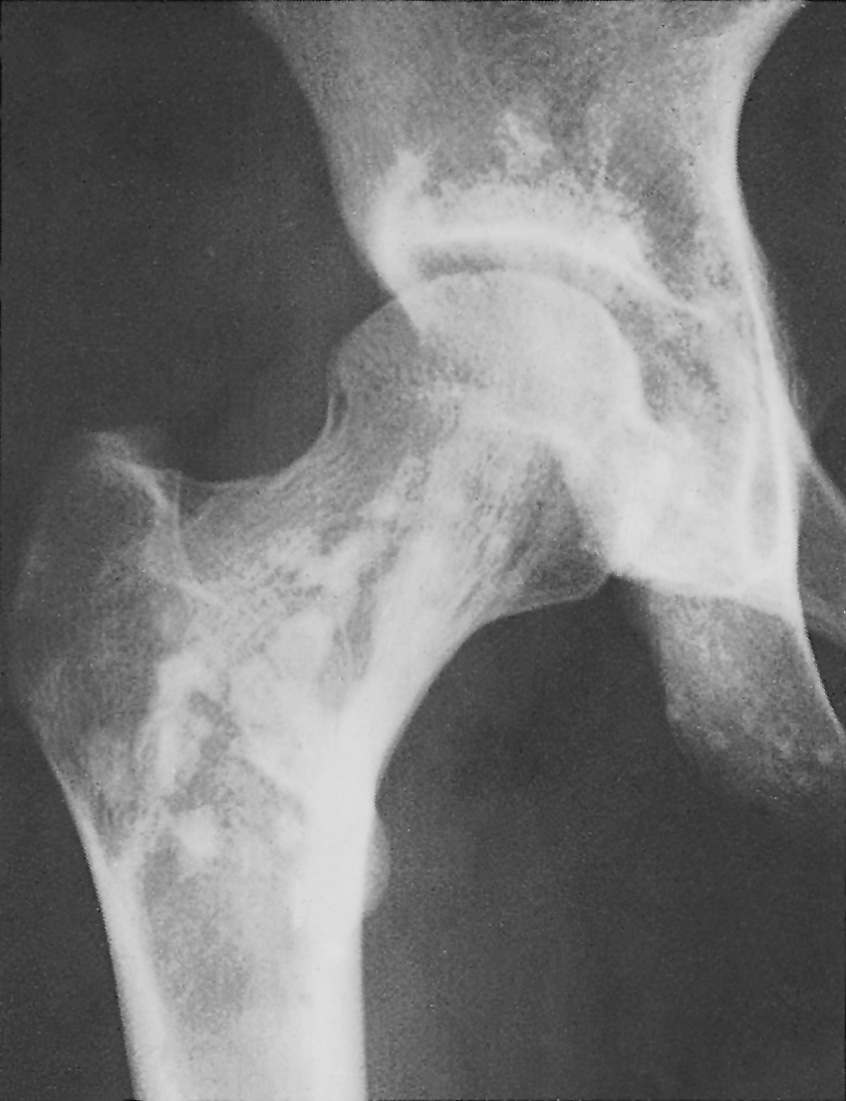 Osteopoikilosis. †