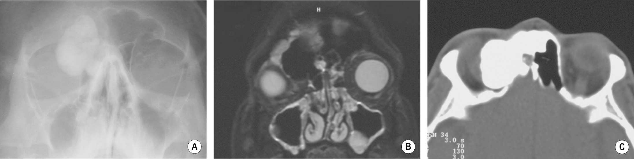 Osteoma. (A) Plain XR. (B) Coronal STIR images underestimate the lesion since bone and air are both black. (C) Axial CT shows extension into the orbit. *