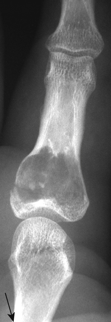AP XR of a proximal phalangeal enchondroma with associated pathological fracture (arrow). *