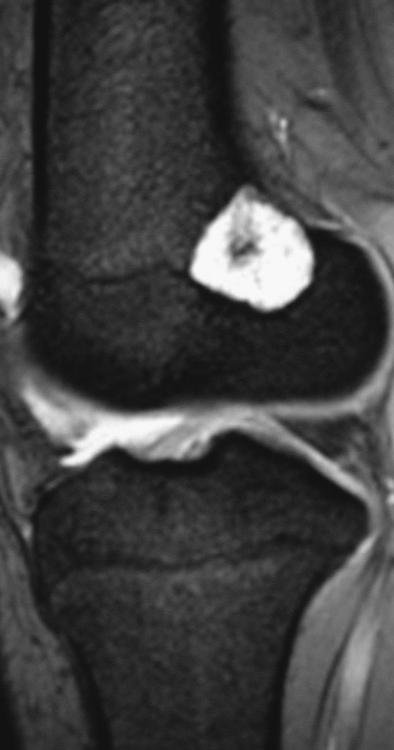 Sagittal T2WI MRI of a distal femoral chondroma – calcification is manifest as focal areas of signal void. *