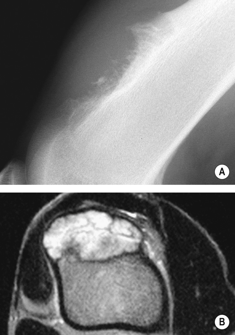 Periosteal chondroma. (A) Lateral XR showing a calcified surface lesion. (B) Axial fat-suppressed T2WI showing a hyperintense lobulated lesion, without medullary infiltration. *