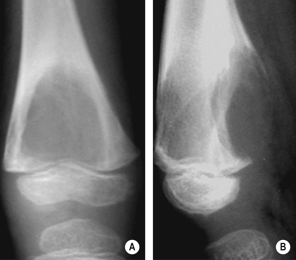 Chondromyxoid fibroma of the distal femoral metaphysis. (A,B) Large osteolytic defect bulging outward. *