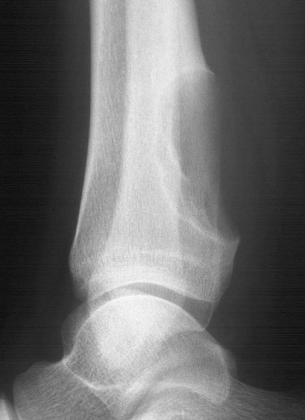 Chondromyxoid fibroma. Lateral radiograph of ankle shows a well-defined, eccentric lytic lesion arising eccentrically within the distal tibial metaphysis. ©35