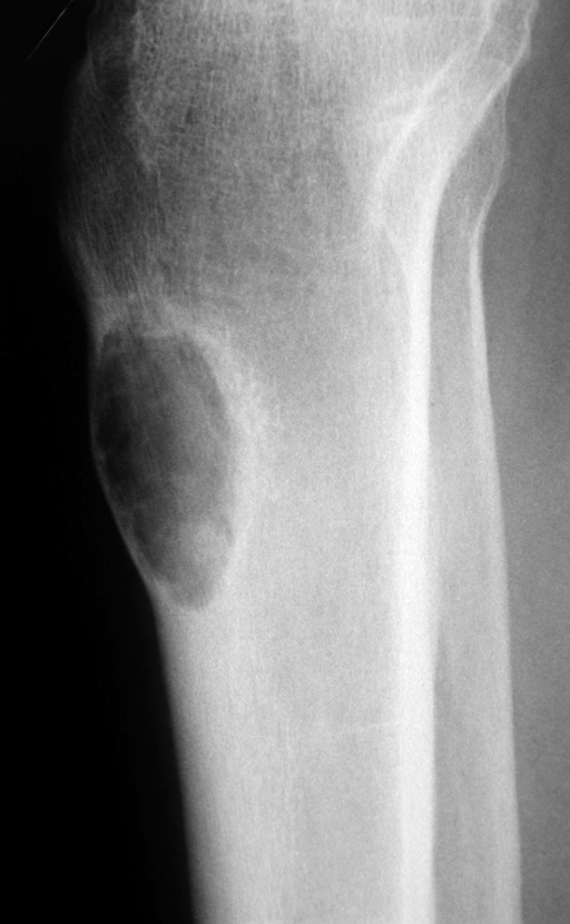 Chondromyxoid fibroma. Lateral XR showing expansion of the anterior cortex. *