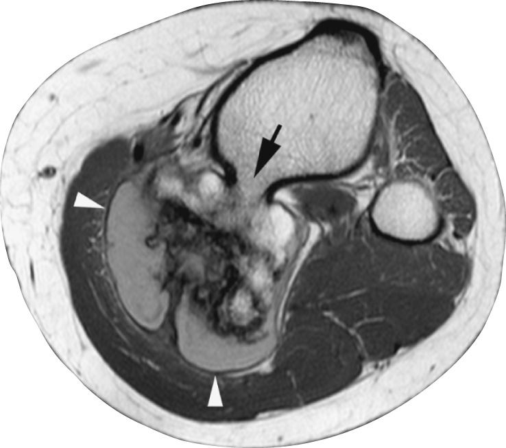 Osteochondroma. MRI features. (A) Axial PDW FSE MRI through the proximal tibia showing medullary continuity (arrow) between the osteochondroma and host bone. The cartilage cap is mildly hyperintense and surrounded by a thin, hypointense perichondrium (arrowheads). **