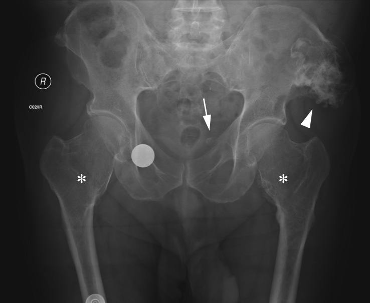 Diaphyseal aclasia demonstrating the typical femoral neck modelling deformity (asterisks), a small osteochondroma arising from the left superior pubic ramus (arrow) and malignant transformation of a left iliac wing osteochondroma (arrowhead). A coin was left in the right pocket.