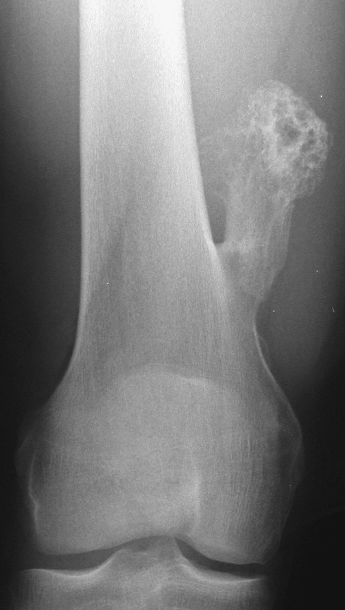 Osteochondroma. AP XR showing a typical pedunculated osteochondroma. *