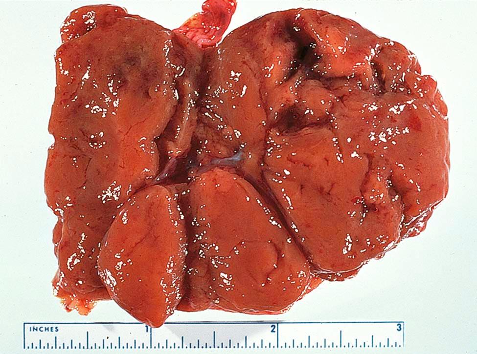 FIGURE 20-1, Gross appearance of a luteoma of pregnancy. Note the multiple brown nodules.