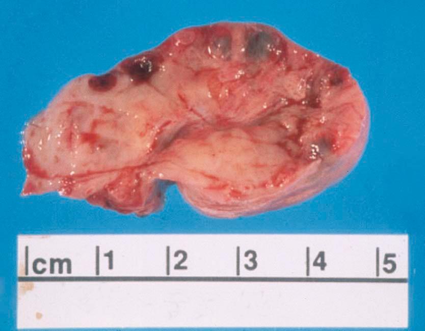 FIGURE 20-2, Ovary with multiple cysts lining the capsule consistent with polycystic ovarian syndrome.