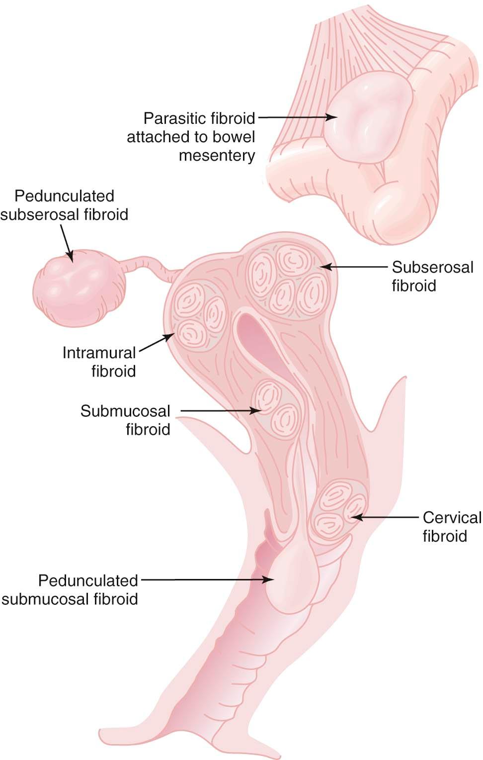 FIGURE 19-1, Uterine leiomyomas (fibroids) in various anatomic locations.