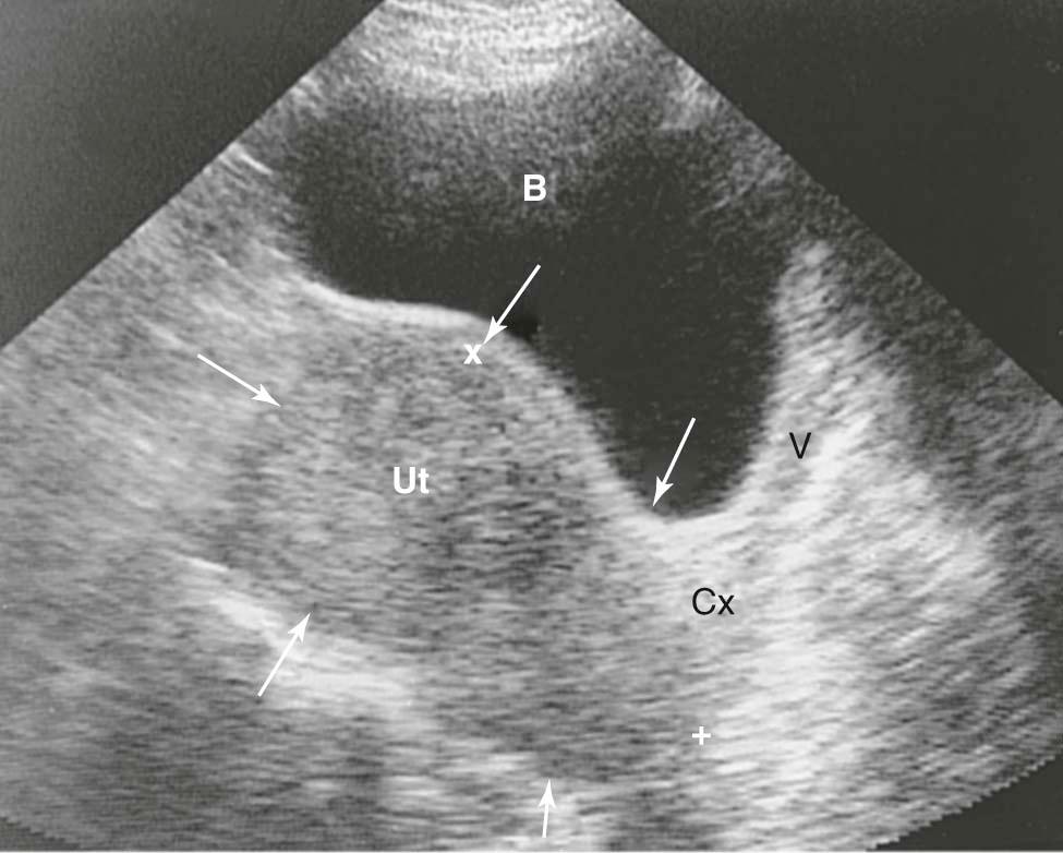 FIGURE 19-2, Ultrasonic image of a uterus enlarged and irregularly distorted by multiple fibroids (arrows). Such studies are useful to help rule out ovarian enlargement too. B, Bladder; Cx, cervix; Ut, uterus; V, vagina.