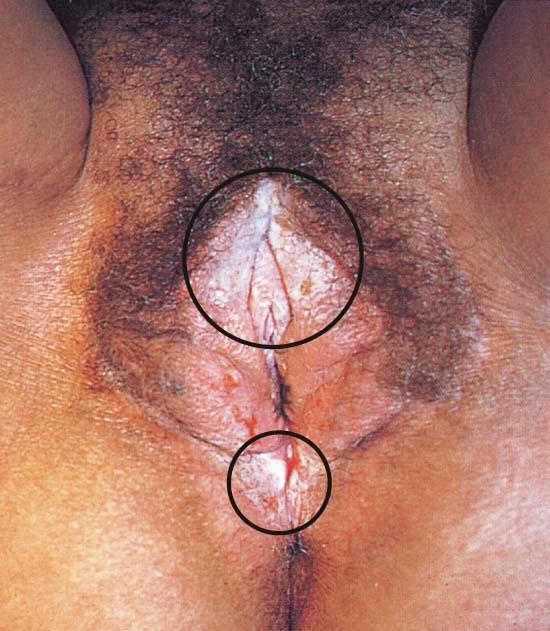 FIGURE 18-1, Vulva with lichen sclerosus (circles) .