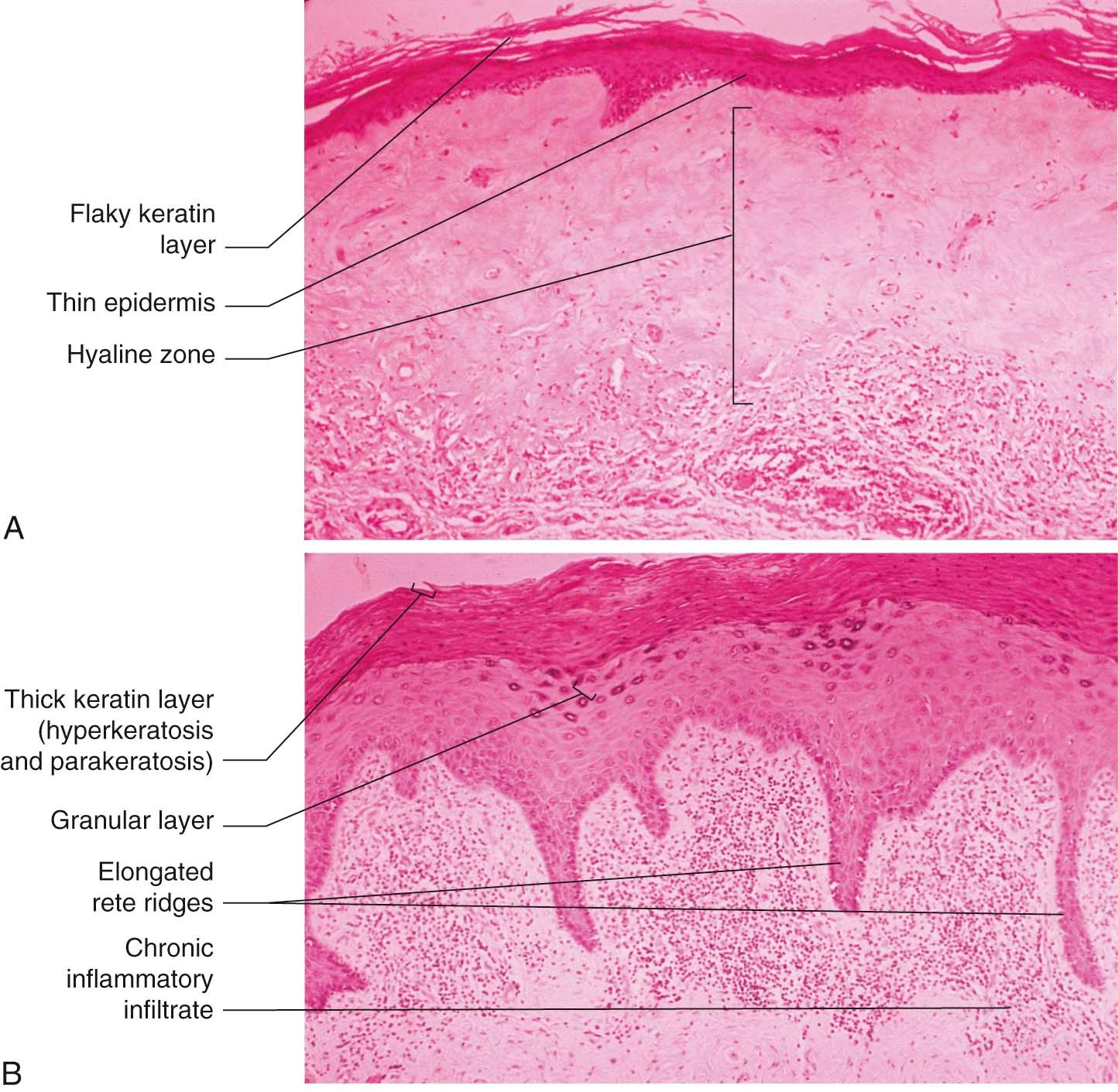 FIGURE 18-2, A, Lichen sclerosus. Histology shows hyperkeratosis but the epidermis is thinner than normal. The most striking feature of lichen sclerosus is the presence of a hyaline zone in the superficial dermis. This is the result of edema and degeneration of the collagen and elastic fibers of the dermis. B, Squamous cell hyperplasia. Microscopy shows marked hyperkeratosis and parakeratosis with a prominent granular layer. Acanthosis, with prolongation of rete ridges, is also seen and there is a dense infiltrate of chronic inflammatory cells, mainly lymphocytes, in the superficial dermis.