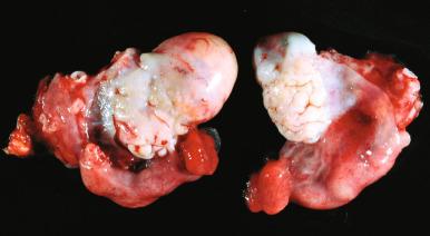 Fig. 22.1, Ovaries from a reproductive-age woman, containing mild surface convolutions. A small fibroma is present on the cortex of the ovary on the left.