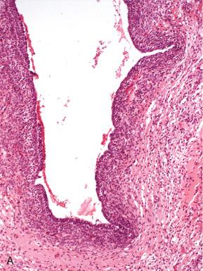 Fig. 22.11, Atretic follicle. A, Cystic atretic follicle with early sclerosis of the follicle wall and dispersal of the thecal cells. B, End-stage follicle atresia, with collapse of the follicle space.