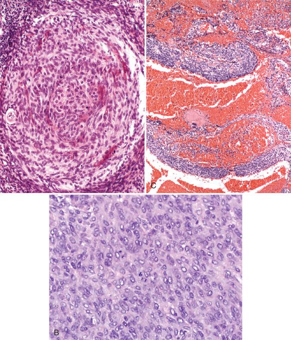 Fig. 22.12, Diagnostic problems in interpreting ovarian follicles. A, Tangential sectioning of theca mimicking neoplasia. B, Higher-power view of mitotic activity. C, Cystic granulosa cell tumor may mimic follicles.