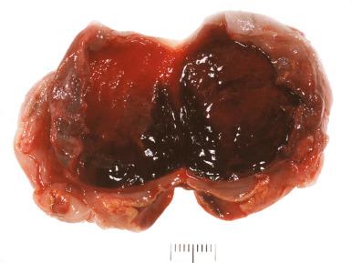 Fig. 22.13, Gross appearance of a recent cystic corpus luteum, with a smooth hemorrhagic lining and yellow rim.