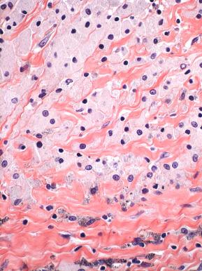 Fig. 22.16, Xanthoma cells lining an endometriotic pseudocyst might mimic luteinized granulosa cells.