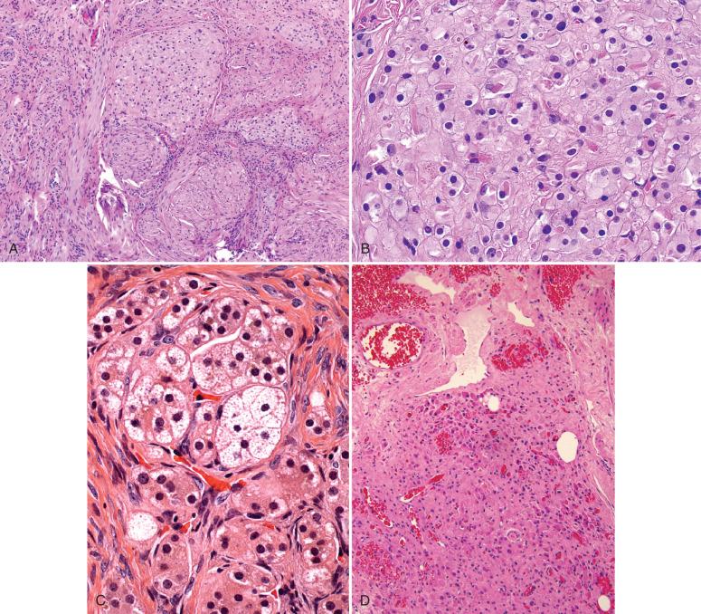 Fig. 22.18, A, Hilus cells. B, Reinke crystalloid in a hilus cell (upper center). C, Lipid-laden hilus cells may mimic an adrenal rest. D, Increased numbers of hilar cells in a menopausal woman.