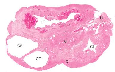 Fig. 22.2, Low-power photomicrograph of the ovarian cortex (C), medulla (M), and hilus (H). CF, Cystic follicle; CL, corpus luteum; LF, luteinized follicle.