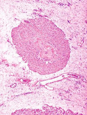 Fig. 22.21, Nodular theca-lutein hyperplasia of pregnancy (NTLHP), characterized by microscopic nodular aggregates of hyperplastic thecal cells.