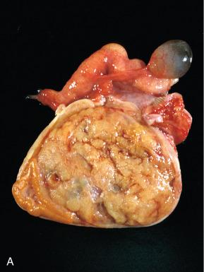 Fig. 22.23, A, Pregnancy luteoma, manifesting as a dominant ovarian mass in this pregnant patient. B, Low-power view of the interface between pregnancy luteoma and the ovarian stroma (upper).