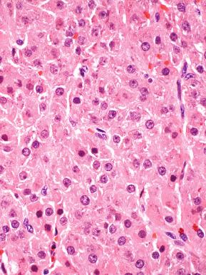 Fig. 22.24, Microscopic view of pregnancy luteoma. The lesion is indistinguishable from a steroid-producing tumor (see Chapter 27 ).