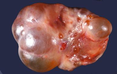 Fig. 22.25, Hyperreactio luteinalis (HRL). The characteristic features are bilateral expansion of the ovaries by multiple cysts.