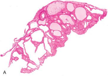 Fig. 22.26, Hyperreactio luteinalis (HRL). A, Low-power microphotograph depicts multiple cystic follicles. B, The follicles are lined by luteinized cells.
