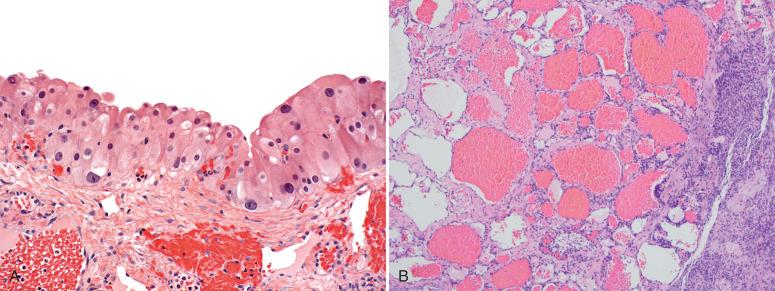 Fig. 22.27, A, Solitary luteinized follicle cyst of pregnancy. The luteinized lining cells exhibit focal atypia. Similar luteinized cysts may be seen in nonpregnant women. B, Another more rarely seen cystic lesion is an ovarian cavernous hemangioma.