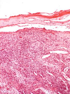 Fig. 22.4, Small fibrovascular adhesions on the ovarian cortex.