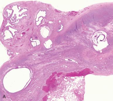 Fig. 22.6, Endosalpingiosis. A, At low power, the impression is that of adhesed tubal epithelium on the ovarian surface. B, Another example illustrates a merging of both endosalpingiosis (upper right) and müllerian inclusions, possibly related. C, Higher magnification of a focus illustrates the prominent cilia. D, Paraovarian müllerian cyst of tubal (or paramesonephric) origin.