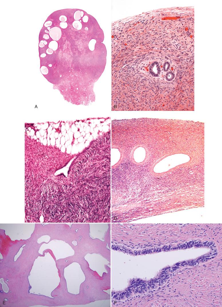 Fig. 22.7, A, Extensive cortical inclusion cysts (CICs). B, Higher-power view of the subsurface CICs. C, CIC forming at interface of the periovarian adhesion. D, Mesothelial-lined atretic follicles are another mechanism for incorporating ovarian surface lining into the ovarian cortex. E, Multiple müllerian epithelial inclusions in the Birt-Hogg-Dubé syndrome. F, These are predominately ciliated akin to CICs or endosalpingiosis.