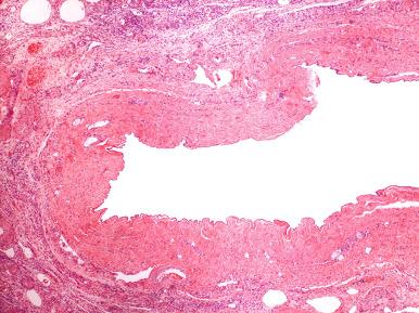 Fig. 22.8, Simple (mesothelial) cyst of the ovary.