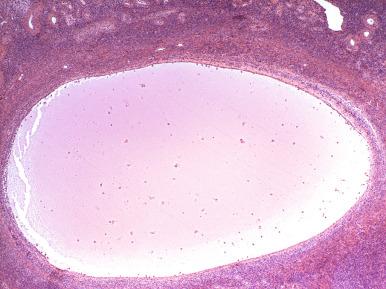 Fig. 22.10, Cystic follicle. Common in reproductive-age women.